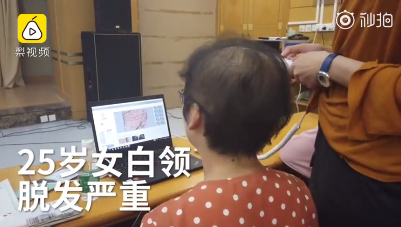 18岁上学压力大脱发怎么调理,17岁孩子脱发严重怎么办