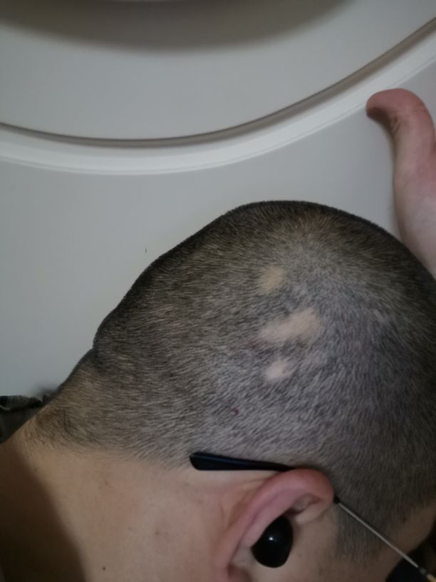 发现斑秃刚好又开始掉头发怎么办,突然发现斑秃怎么治疗