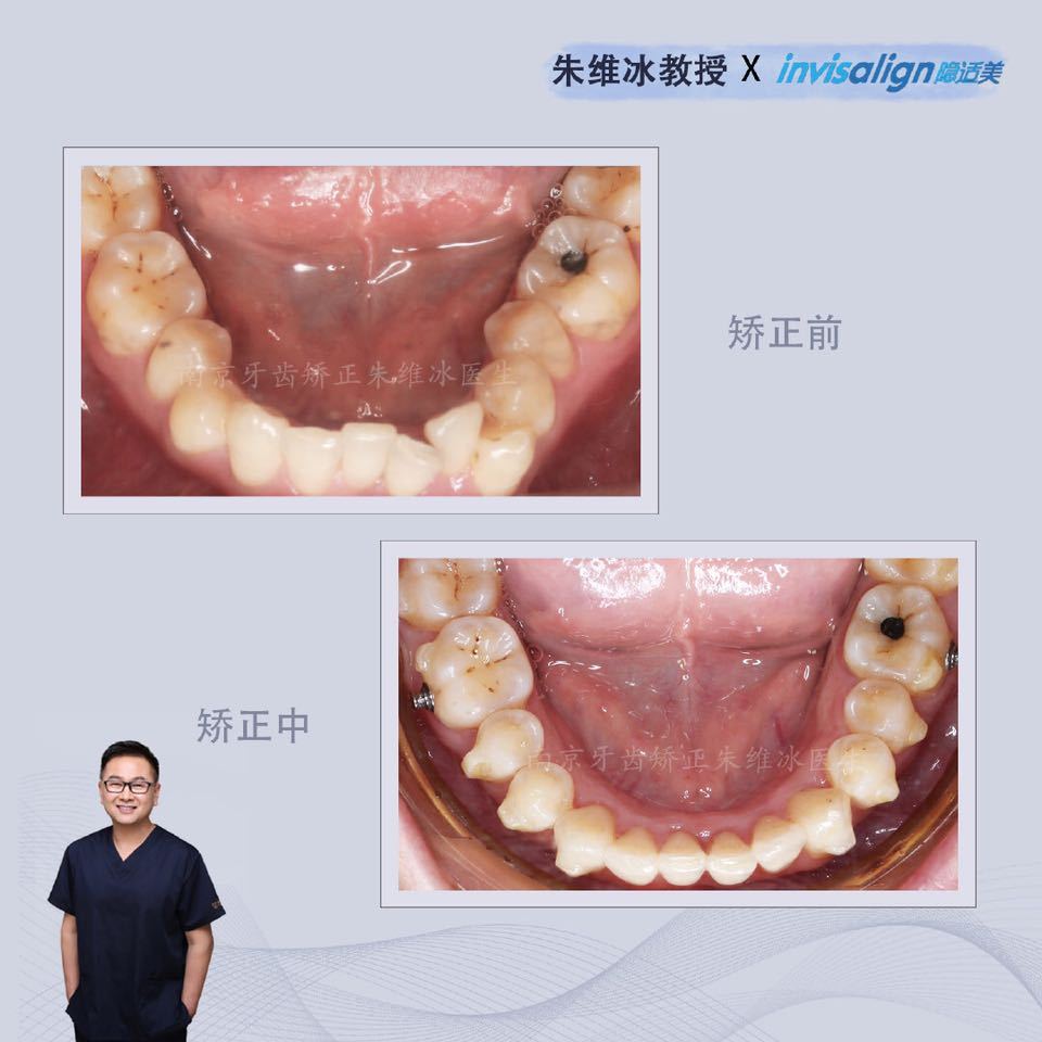 隐适美牙齿拥挤矫正真实案例,南京朱维冰