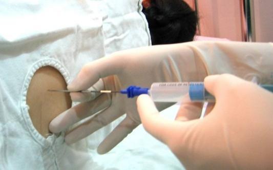 剖腹产产妇拔掉尿管后的排尿护理,剖腹产后拔了尿管怎么快速排尿