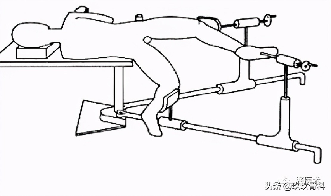 髓内钉技巧,髓内钉教学视频讲解