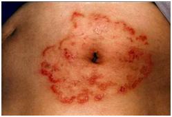 夏日如何远离体癣缠身你了解吗,长期皮癣体癣特别痒教你简单1招