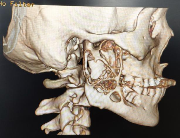 口腔龋齿发病原因讲座,口腔医生科普龋齿处理