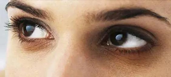 黑眼圈是不是熬夜熬的,有黑眼圈真是因为熬夜吗