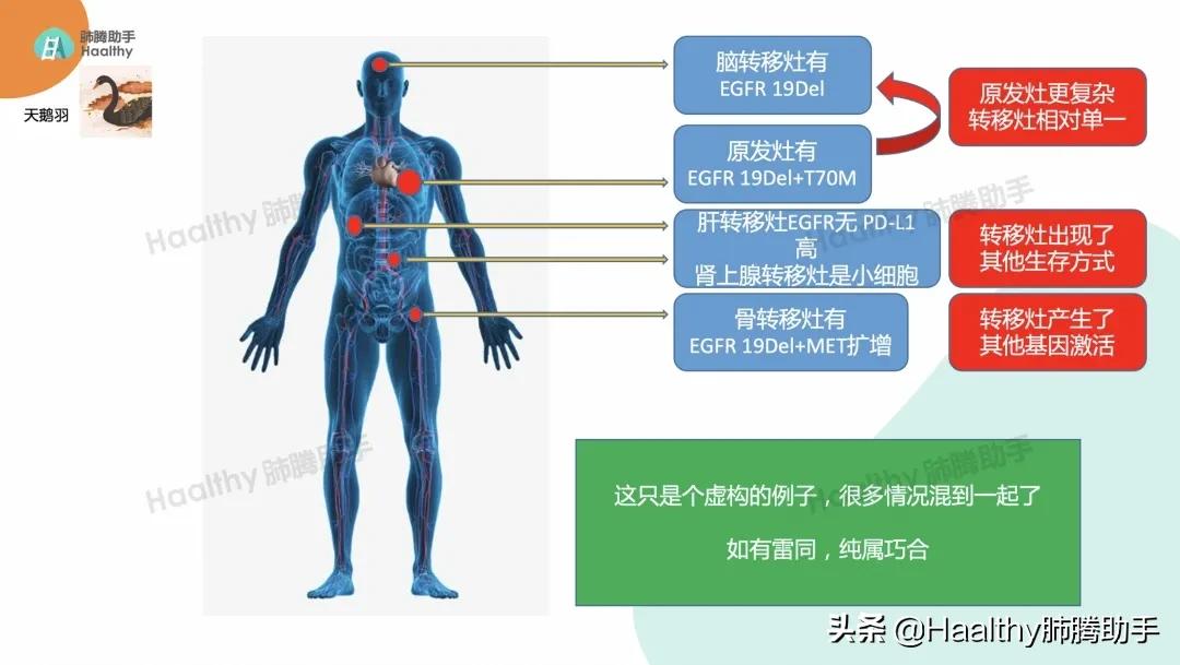 肺癌伴有骨转移最好的治疗办法,肺癌靶向治疗后骨转移怎么办