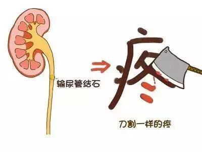 前列腺肥大经常尿路结石如何预防,尿路结石预防与随访