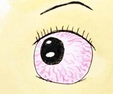 世界青光眼周2018年3月11-17日,世界青光眼日提防隐性致盲