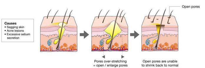 缩小毛孔的最有效方法是什么,缩小毛孔最有效的方法是什么