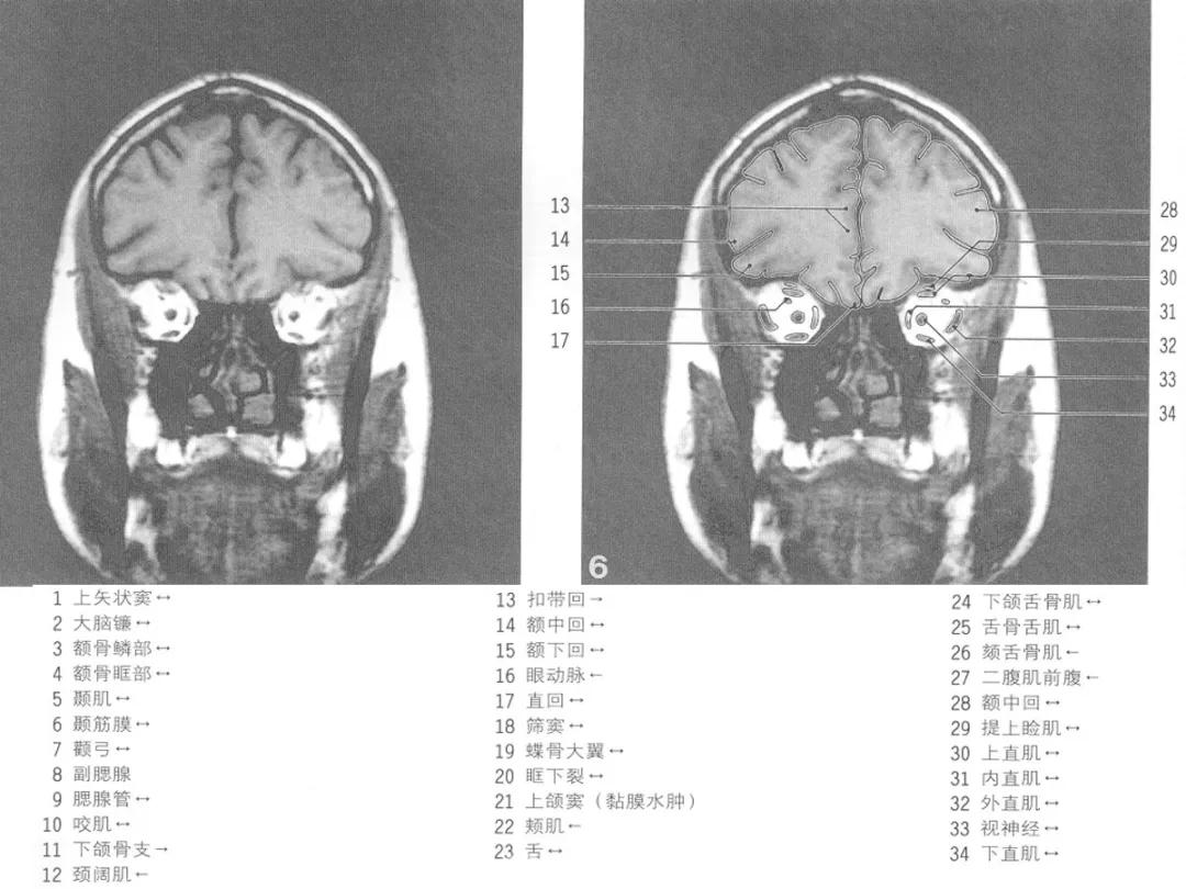 颅脑冠状状切面解剖图,颅脑mr解剖结构图