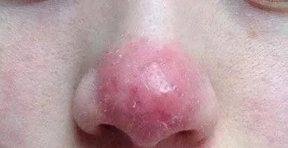 皮肤敏感泛红起皮怎么办,敏感肌皮肤发红怎么调理