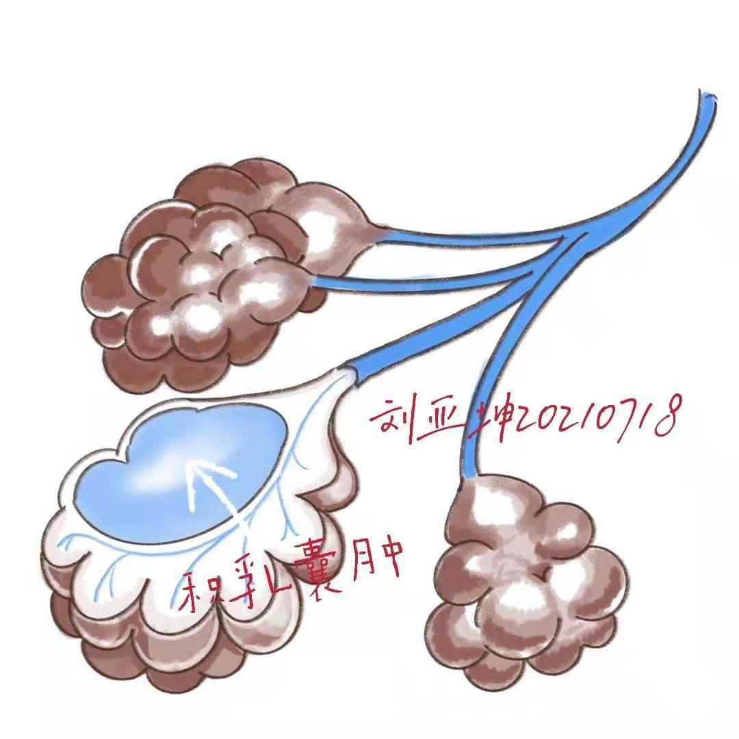 哺乳期乳房疙疙瘩瘩，影响喂奶吗？