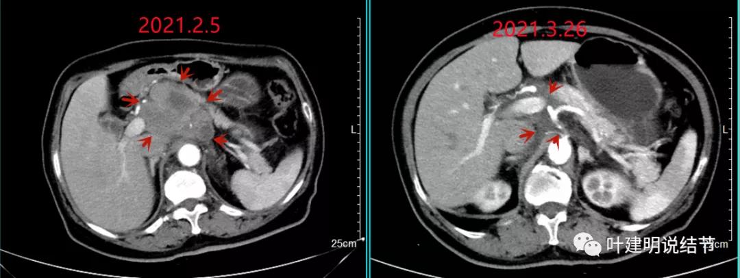 特瑞普利单抗食管癌成功案例,特瑞普利单抗治疗食管癌效果好吗