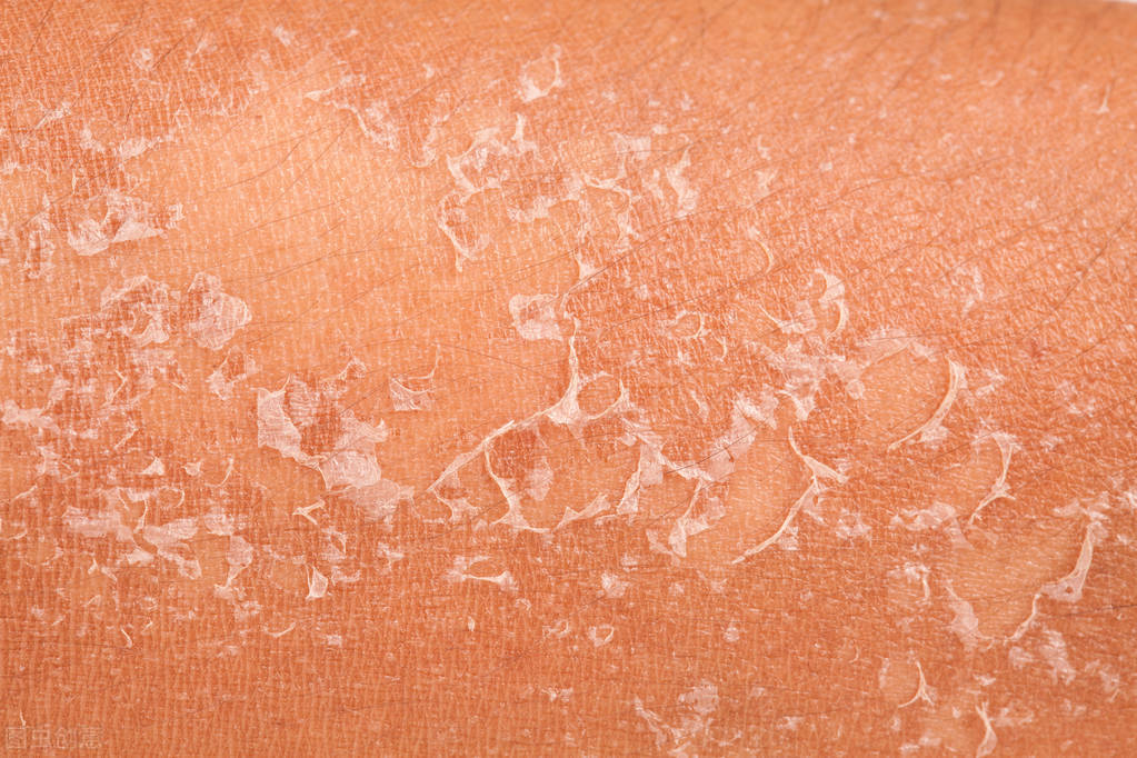 关于皮炎的注意事项有哪些,得了皮炎需要注意什么