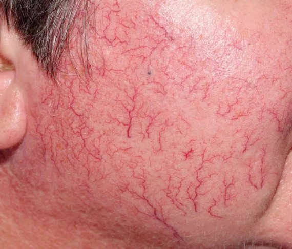 治疗红血丝最好的方法,如何科学治疗红血丝