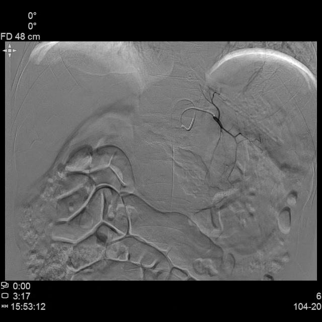 胃癌晚期化疗一次多少钱,胃癌晚期不化疗用靶向药