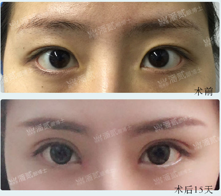 开内眼角失败留疤了怎么办,开外眼角恢复期间会有紧绷感么