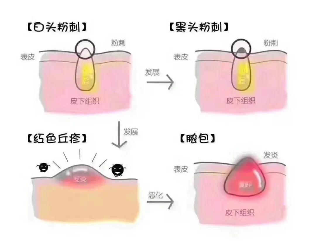 痘肌调理最佳方法美容院,怎么调理脸部痘肌