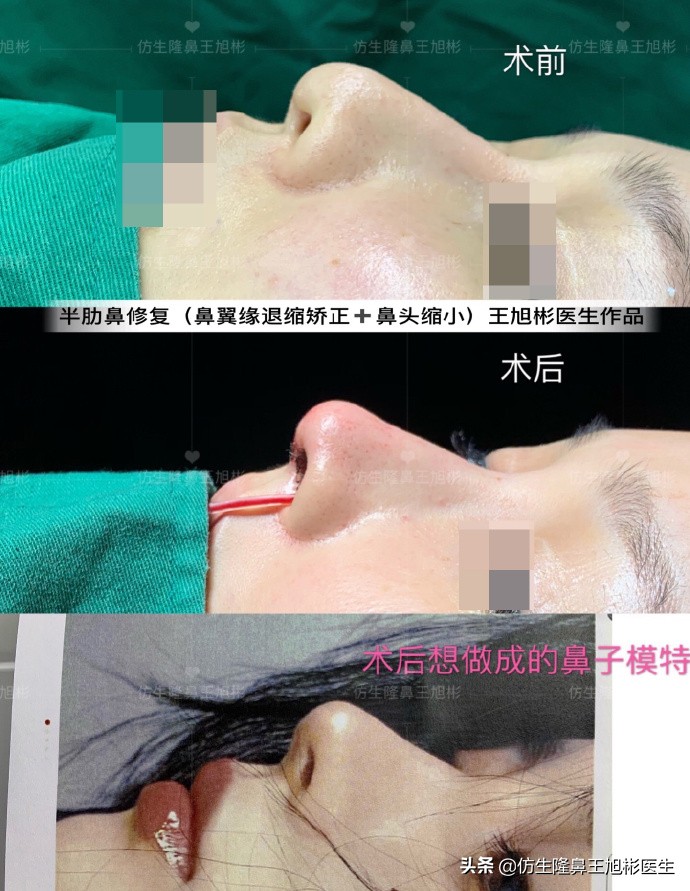 隆鼻的鼻翼怎么修复,隆鼻后多久可以做鼻翼缘矫正