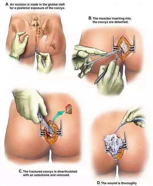 女的尾骨骨折恢复大忌,尾骨骨折多久可以上班