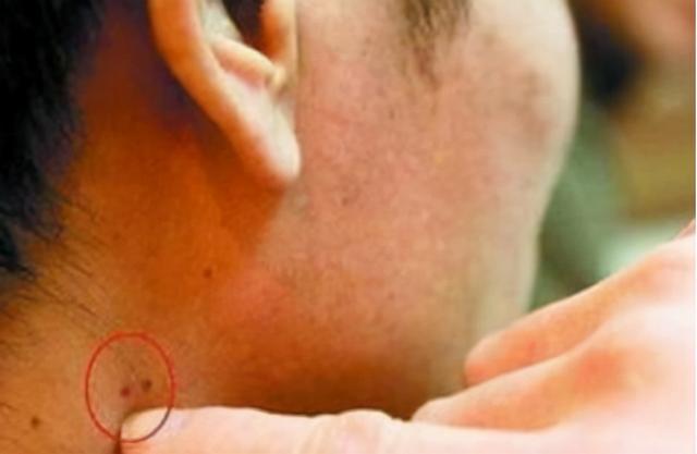 艾滋病在皮肤上会出现什么症状,皮肤灼热疼痛是艾滋病症状吗