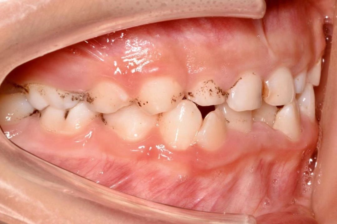 宝宝牙齿上黑点是蛀牙吗,宝宝牙齿有黑点怎么挽救