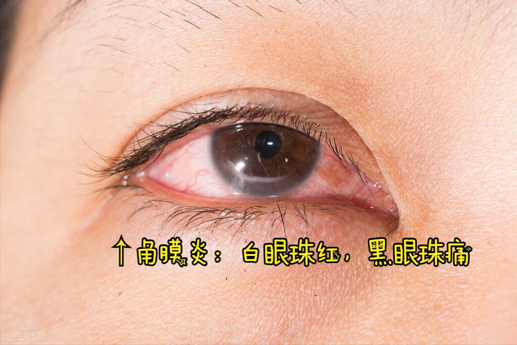 角膜炎属于眼底病吗,眼睛角膜炎是由什么引起的
