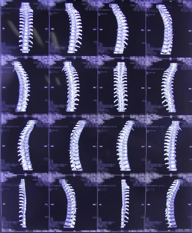 椎管内肿瘤跟椎管肿瘤一样吗,椎管内肿瘤是癌吗