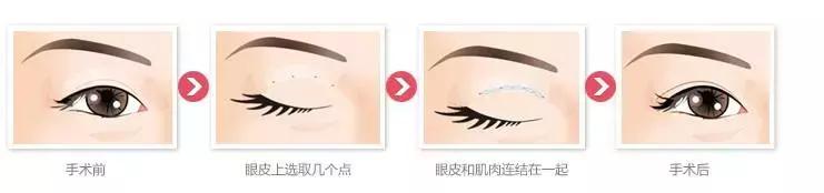 双眼皮眼袋手术揭秘,双眼皮手术时最全攻略