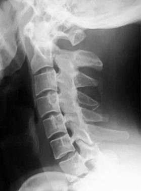 青少年颈肩疼,青少年颈肩酸痛什么原因