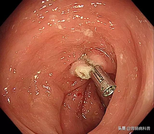 长了胃息肉怎么办,长了胃息肉怎么办才好