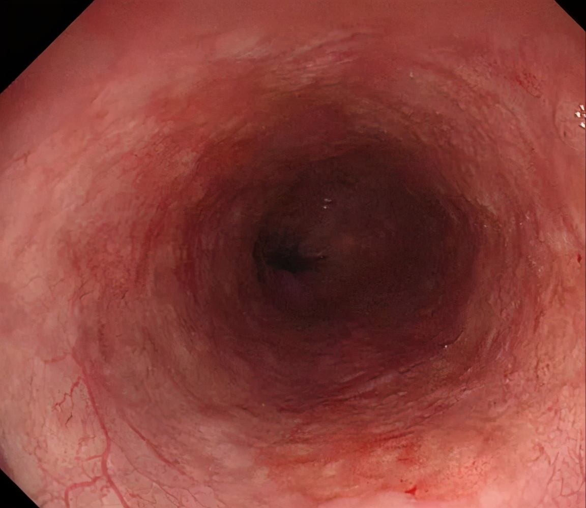 早期食管癌的病变范围是,早期食管癌手术费用多少