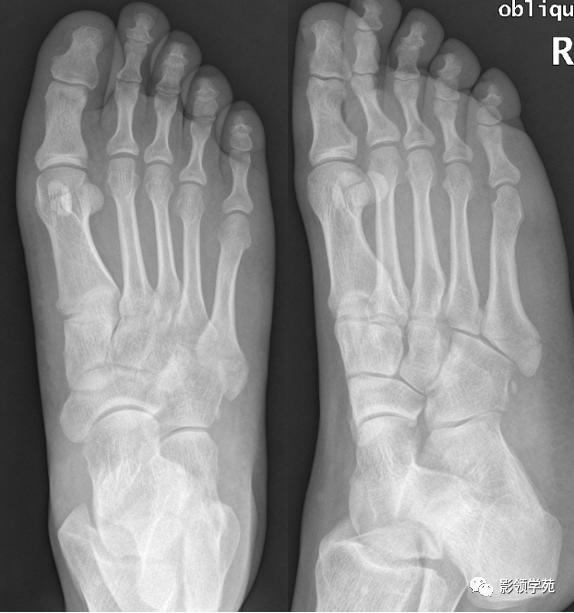 桡骨远端骨折引起尺骨变异,撕脱骨折一个月无明显骨痂形成