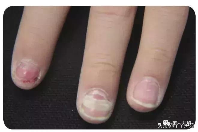 麻疹水痘猩红热手足口病区别,猩红热手足口病怎么治