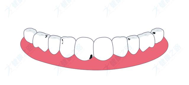 缺牙前后牙都蛀牙了需要怎么补,牙齿牙龈萎缩不整齐有蛀牙有缺牙
