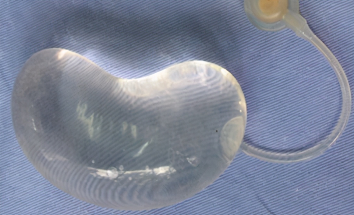 耳再造一期扩张手术过程,耳再造手术北京好还是上海好呢