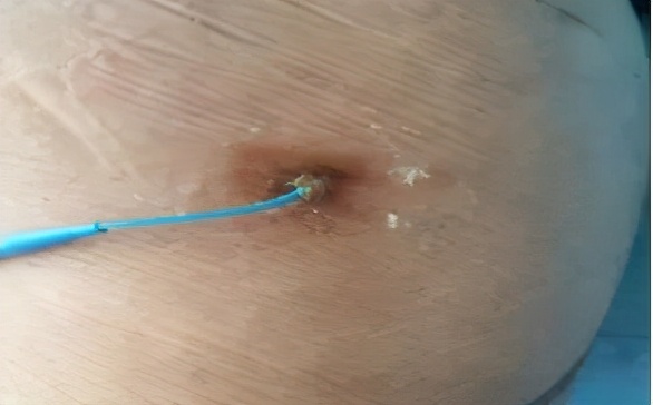 碘伏治疗PICC导管穿刺点感染的体会