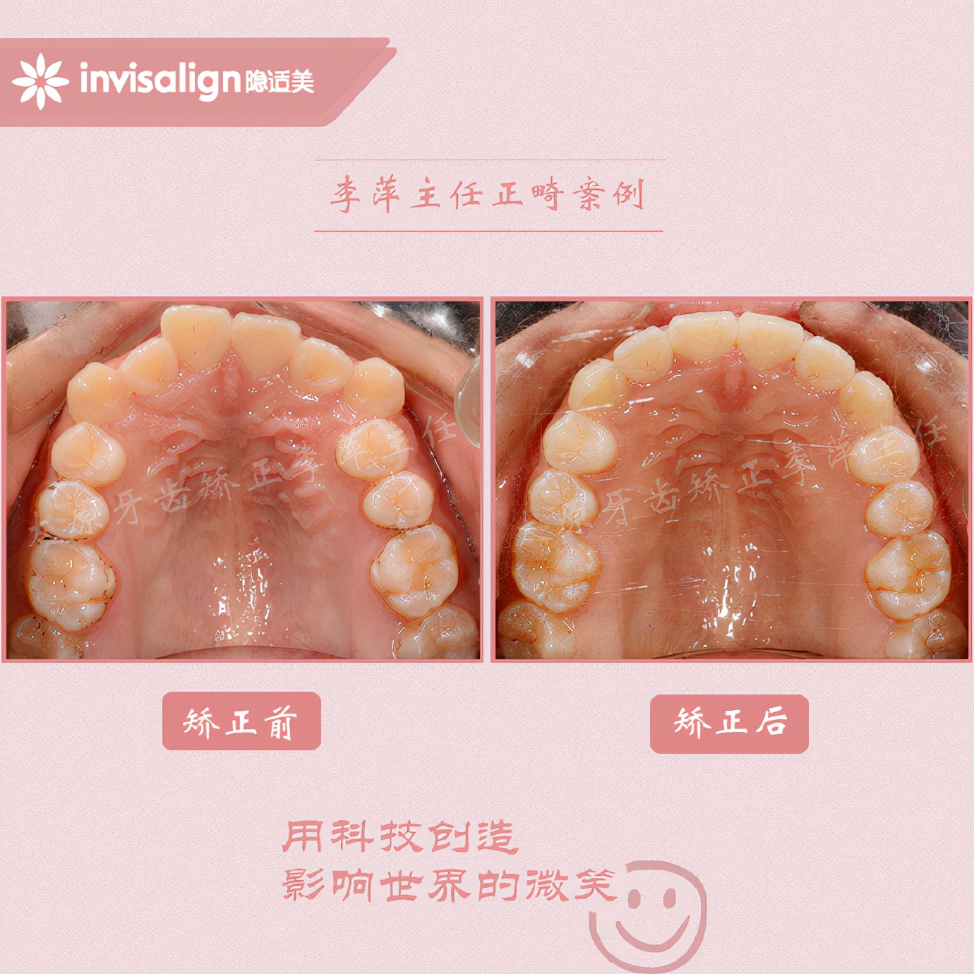 太原牙齿隐形矫正,太原牙齿正畸贵吗