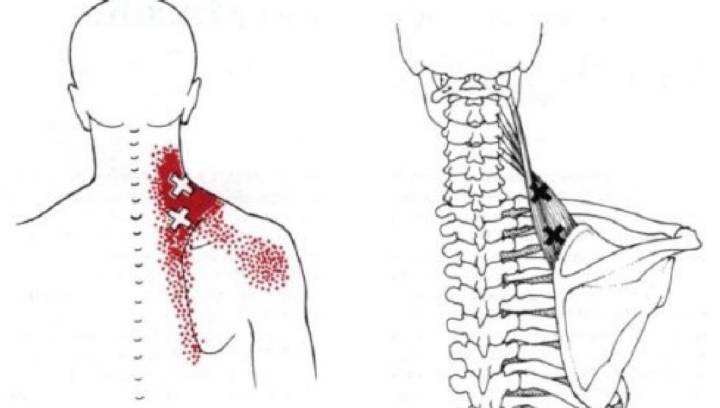 倒车不能回头，硬扭出现疼痛，当心是肩胛提肌出了问题