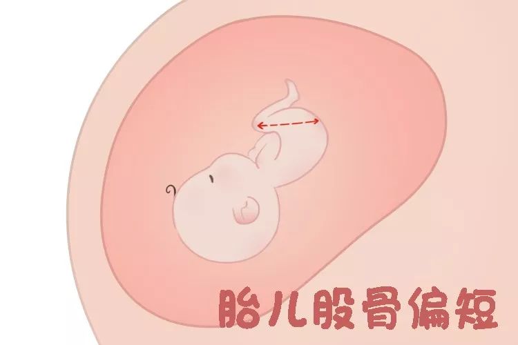 胎动异常胎儿缺氧可能性大吗,胎动异常感觉胎儿横位