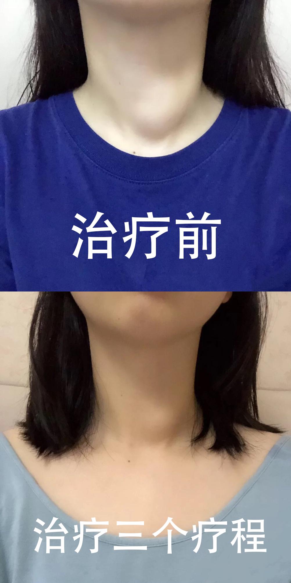 甲状腺结节中药处方单,消除甲状腺结节的食疗汤有哪些