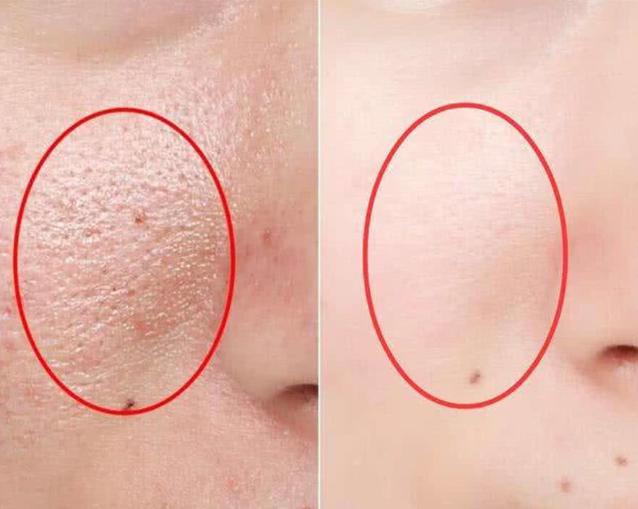 螨虫钻进皮肤怎么办,螨虫钻入背部毛囊怎么办