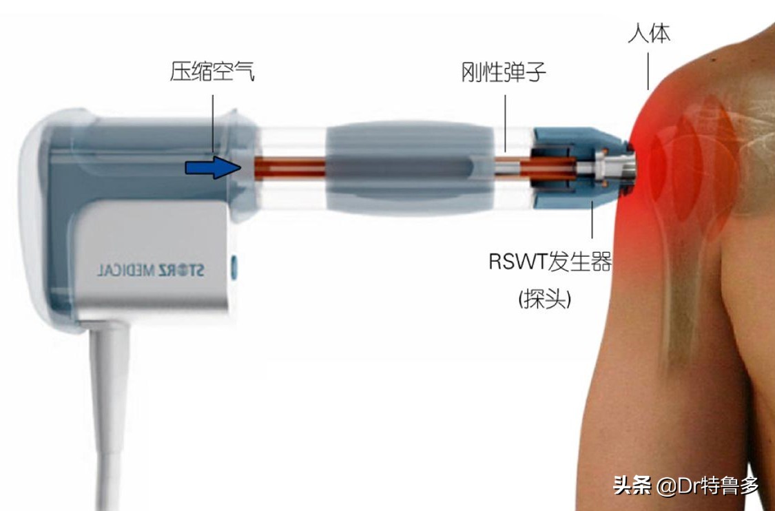 骨折久不愈合做冲击波有效吗,冲击波对骨不愈合有帮助吗