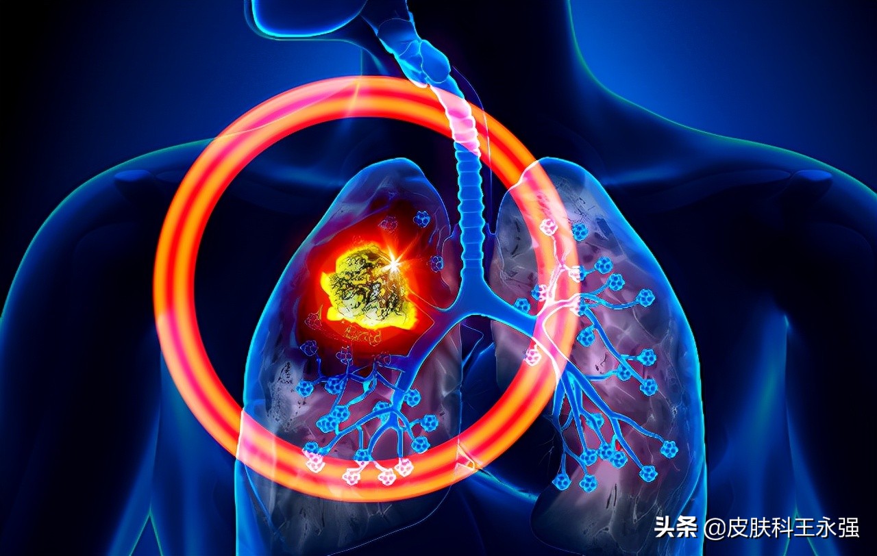 乳腺癌术后又发现肺结节，是转移还是原发肺癌？