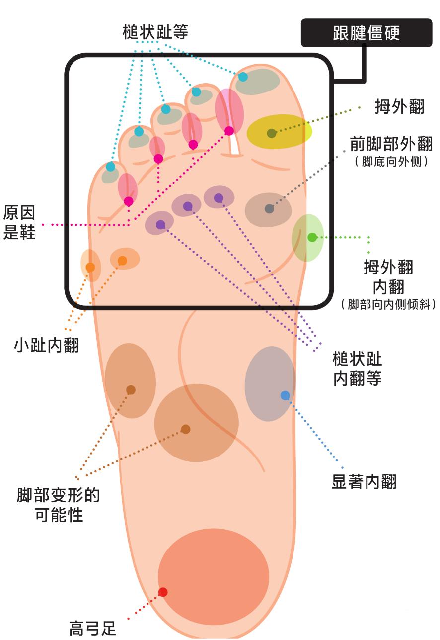 脚底的老茧怎么才能根治,老茧下的鸡眼