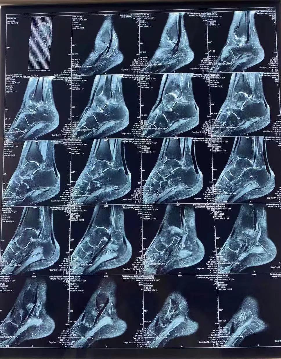 踝关节损伤没肿是不是就没事,踝关节损伤一周没有消肿