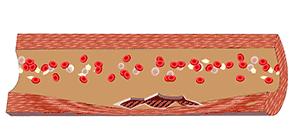 血管堵塞动态图片,血管疏通动图