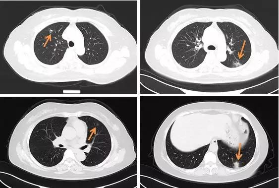 新型冠状病毒肺炎相关知识答疑,新型冠状病毒肺炎必须知道什么