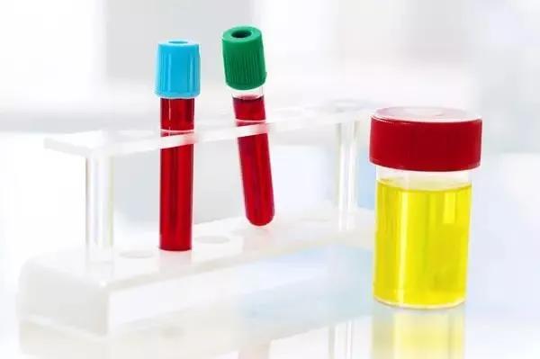 尿血是不是有病,肾病尿血危及生命吗