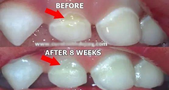 怎么改善蛀牙,怎样治疗牙齿痛和蛀牙