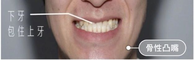 矫正牙齿可以改善凸嘴吗,凸嘴做正颌手术还是矫正牙齿好呢